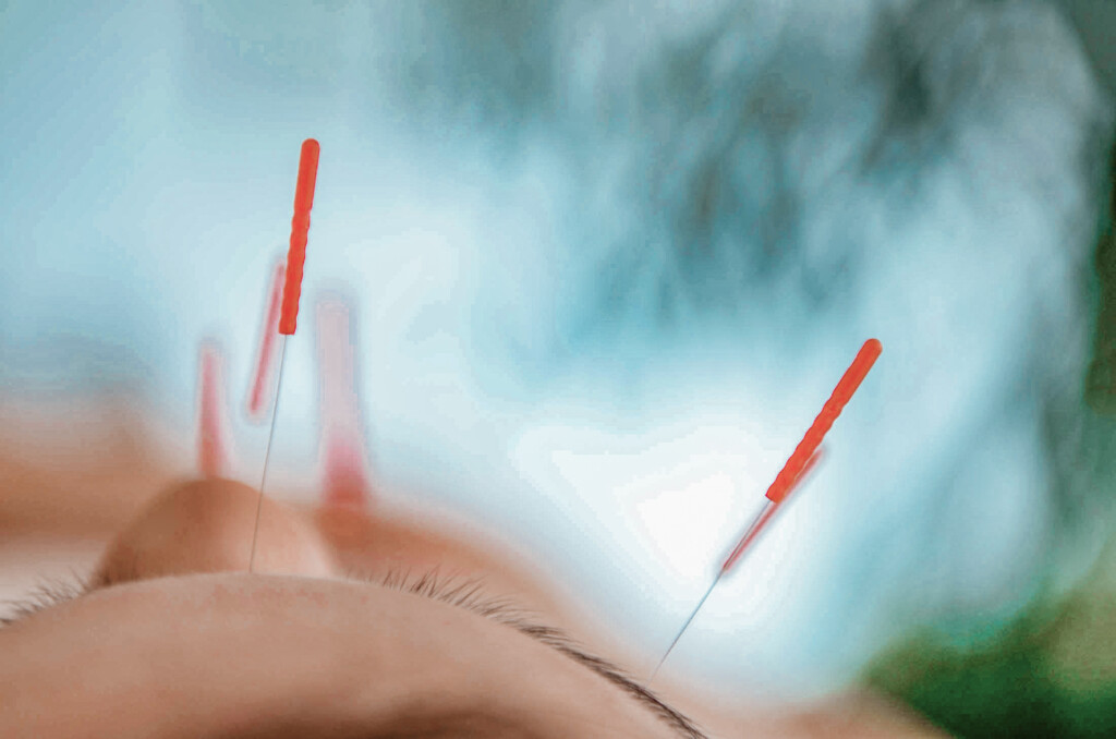 Insights Greece - Better than Botox? Trying Cosmetic Acupuncture in Athens